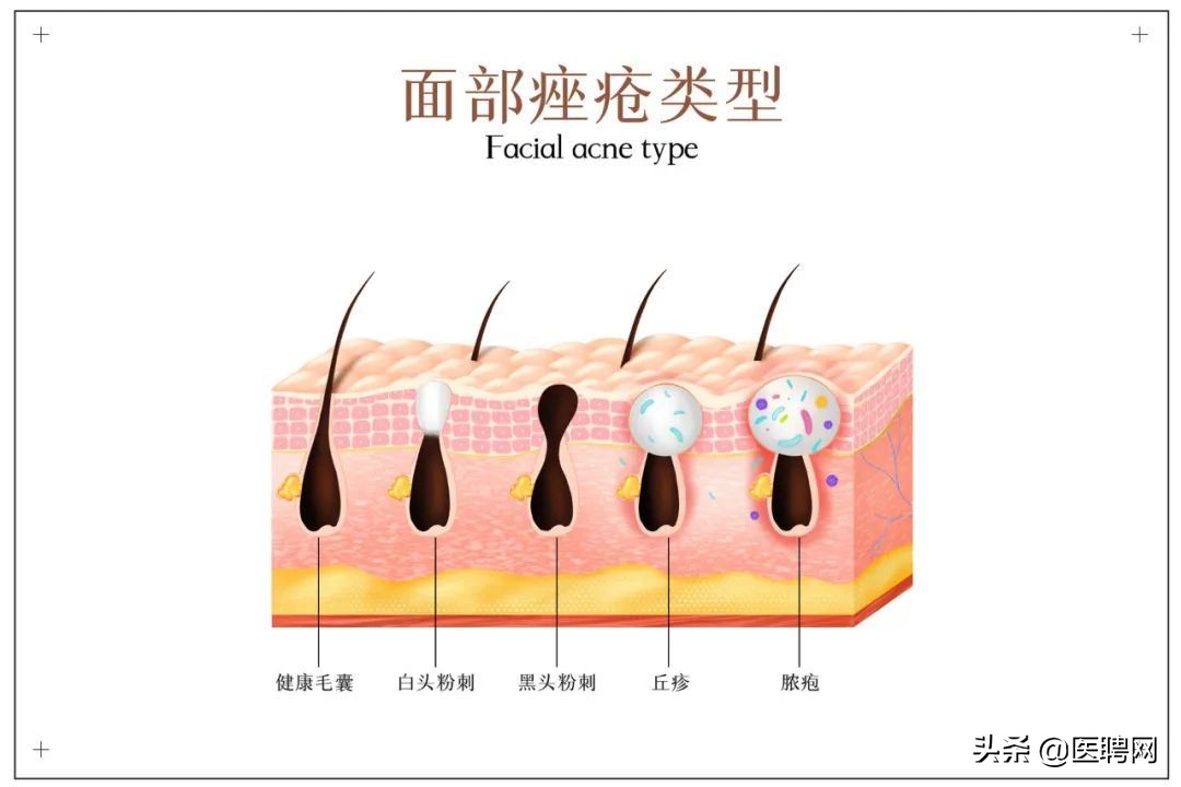 痘印痘坑怎么消除_痘印痘坑的消除方法