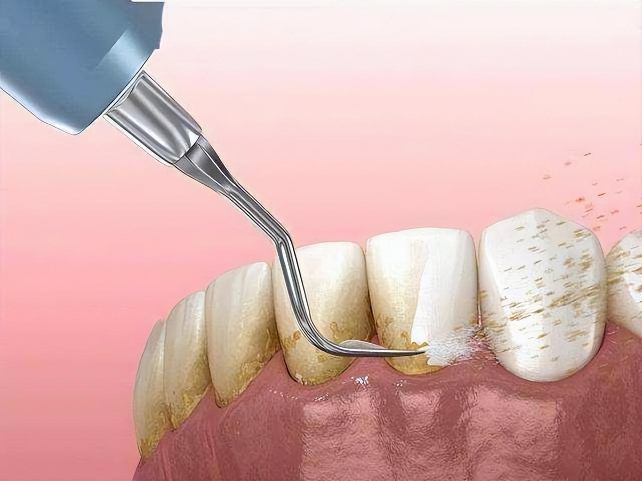 牙结石可以自己抠掉吗_牙结石的去除方法